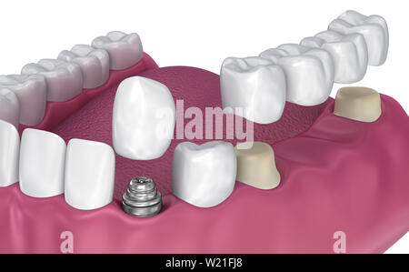 Zahn feste Brücke, Implantat und Krone. Medizinisch genaue 3D-Darstellung Stockfoto