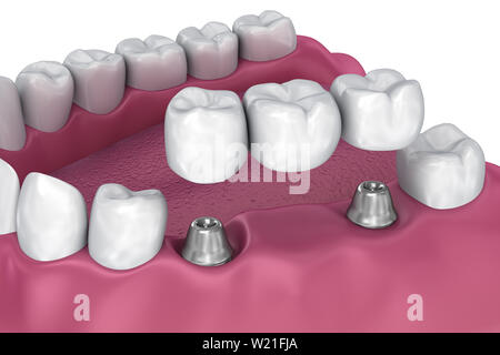Unterstützt feste Brücke Implantat. Medizinisch genaue 3D-Darstellung Stockfoto