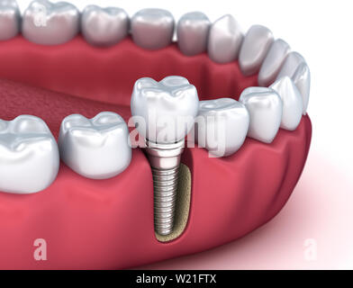 Zahn instalation Prozess Implantat, Medizinisch genaue 3D-Darstellung Stockfoto