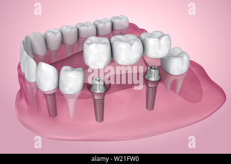 Unterstützt feste Brücke Implantat. Transparente Ansicht. Medizinisch genaue 3D-Darstellung Stockfoto