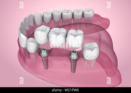 Unterstützt feste Brücke Implantat. Transparente Ansicht. Medizinisch genaue 3D-Darstellung Stockfoto