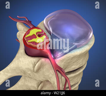 Hernaited Disc in der menschlichen Wirbelsäule in Details Stockfoto