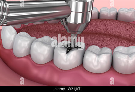 Zahnmedizinische Riss, Füllungen, Medizinisch genaue 3D-Darstellung Stockfoto