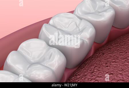 Zahnmedizinische Riss, Füllungen, Medizinisch genaue 3D-Darstellung Stockfoto