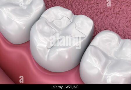 Zahnmedizinische Riss, Füllungen, Medizinisch genaue 3D-Darstellung Stockfoto