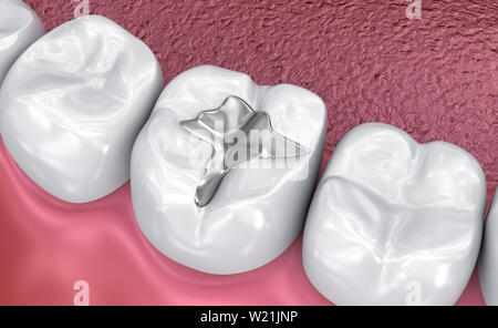 Zahnmedizinische Riss, Füllungen, Medizinisch genaue 3D-Darstellung Stockfoto