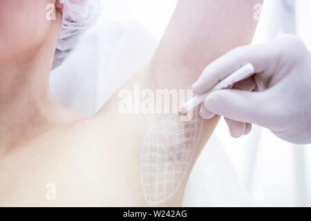 Dermatologe Markierung auf den Achseln der Frau für übermäßiges Schwitzen Behandlung, close-up. Stockfoto