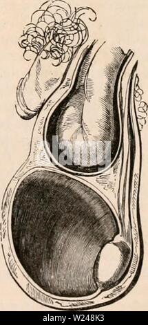 Archiv Bild von Seite 216 des cyclopaedia von Anatomie und. Die cyclopaedia von Anatomie und Physiologie cyclopdiaofana 0402 Todd Jahr: 1849 offen gelegt, und ein Teil der parietes der Encysted hydrocele und schneiden Sie Ihre Innenräume zu entlarven. Die Position der Hoden ist so verändert, dass der anterioren Grenze nach unten gerichtet ist. Bei der Untersuchung der Körper eines Mannes, der Krankheit des Herzens starb, fand ich auf der rechten Seite eine verdickte und leeren seröse Pouch, Verlängerung für ungefähr einen Zoll und eine Hälfte unterhalb der externen Abdominal- ring. Direkt darunter wurde eine unabhängige Zyste, die in der Lage ist, containi Stockfoto