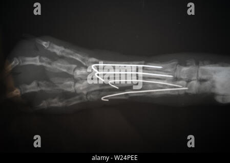 Radiographie eines Hundes Pranke. Echten x-ray Bild eines verletzten Hund Pfote. Stockfoto