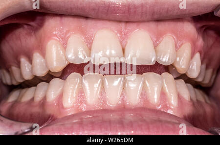 Gesunde menschliche Zähne mit normaler Okklusion von frontalen intraorale anzeigen Stockfoto