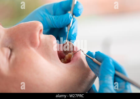 Junge Menschen, die in der Zahnarztpraxis. Zahnarzt Hände in Handschuhe mit Ultraschall, um die Zähne sauber Patienten. Nahaufnahme des offenen Mund. Stockfoto