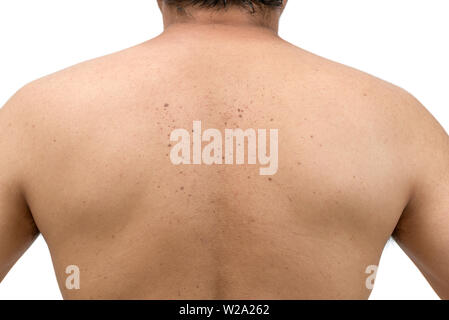 Geschlossen bis die Haut tags oder Seborrhoische Keratose auf der Rückseite Mann auf weißem Hintergrund. Health Care Konzept Stockfoto