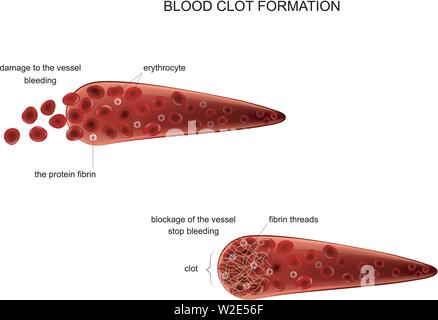 Vector Illustration der Bildung eines Blutgerinnsels Stock Vektor