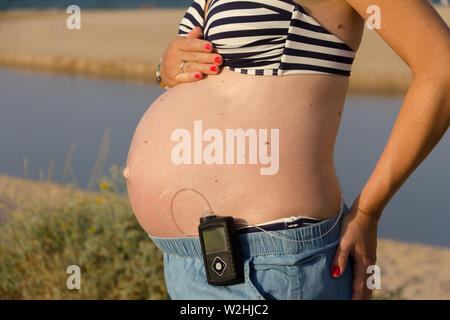 Eine diabetische schwangere Frau mit einer Insulinpumpe am Strand. Sie trägt einen blauen Rock und einem gestreiften Bikini Top. Stockfoto