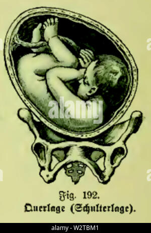 Die Frau als Hausärztin (1911) 192 Querlage (schulterlage) Stockfoto