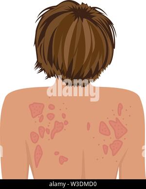 Ekzem betroffen ein Rücken und Schultern. Dermatologie Haut Krankheit Konzept Vector Illustration auf weißem Hintergrund Stock Vektor