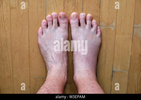 Männliche rechten Fuß geschwollen nach wilden Bienenstich, Seite an Seite und zu den normalen Suche linken Fuß verglichen. Stockfoto