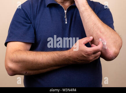 Close up Dermatitis auf Haut, Kranke allergischen Ausschlag Dermatitis Ekzem, atopische Dermatitis des Patienten symptom Skin detail Textur, Pilz das Konzept derma Stockfoto