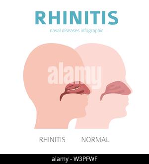 Nasale Krankheiten. Rhinitis Symptome, Behandlung Icon Set. Medizinische Infografik Design. Vector Illustration Stock Vektor