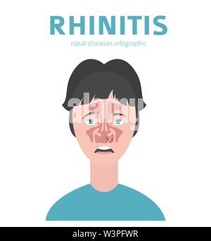 Nasale Krankheiten. Rhinitis Symptome, Behandlung Icon Set. Medizinische Infografik Design. Vector Illustration Stock Vektor