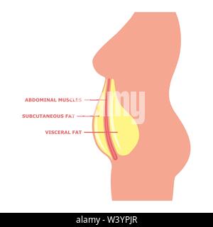 Viszerales Fett auf den weiblichen Körper mit Inschriften Stock Vektor