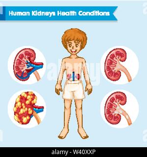 Wissenschaftlichen Medizinischen Abbildung von Nierenerkrankungen Abbildung Stock Vektor