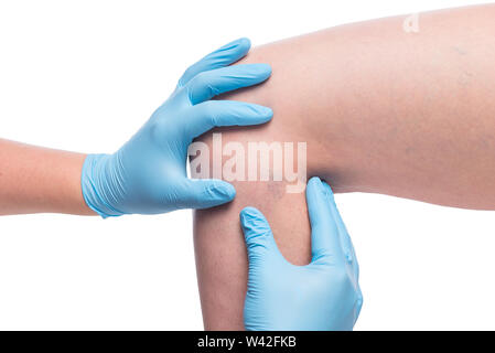 Arzt und Patienten mit Krampfadern am Bein, close-up medizinisches Problem Stockfoto