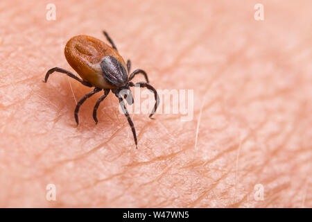 Infizierten weiblichen Rotwild tick auf haarige menschliche Haut. Ixodes ricinus. Parasitische milbe. Acarus. Gefährliche beißende Insekten auf dem Hintergrund der rosa Epidermis detail. Stockfoto