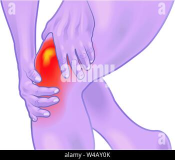 Ein Beispiel für das Knie mit einer Entzündung des Schleimbeutels Stock Vektor