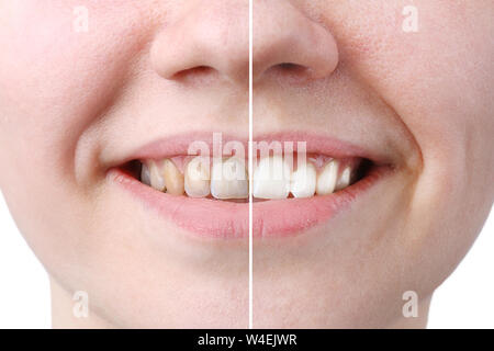 Weiß werden oder die Behandlung bleichen, vor und nach, Frau Zähne und Lächeln, Nahaufnahme, auf weißem Hintergrund. Stockfoto