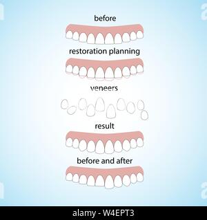 Veneers Zahnmedizin, tolles Design für jegliche Zwecke Stock Vektor