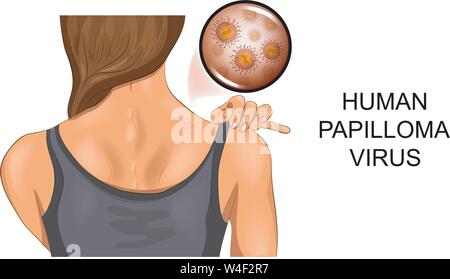 Vector Illustration des menschlichen Papillomavirus auf weibliche zurück Stock Vektor