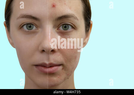 Vergleich Porträt einer Frau mit problematischer Haut ohne und mit Make-up. Stockfoto