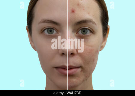Vergleich Porträt einer Frau mit problematischer Haut ohne und mit Make-up. Stockfoto