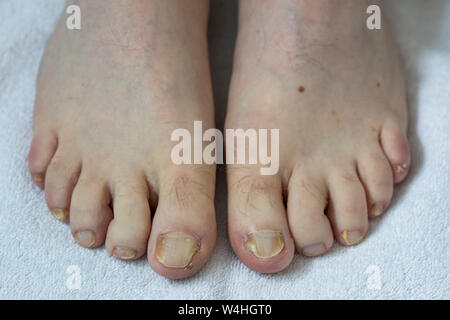 Füße, Zehennägel, mit Nagelpilz Befall, Stockfoto