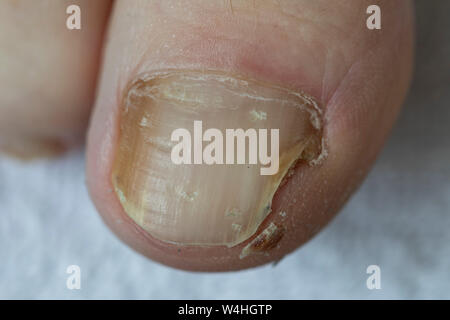 Füße, Zehennägel, mit Nagelpilz Befall, Stockfoto