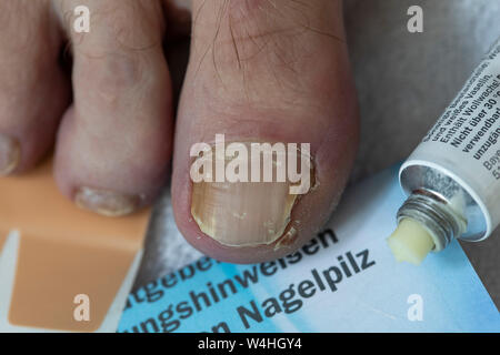 Füße, Zehennägel, mit Nagelpilz Befall, Salbe, anit Pilz Salbe Stockfoto