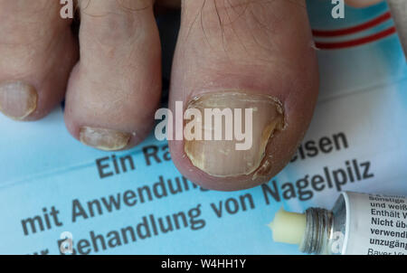 Füße, Zehennägel, mit Nagelpilz Befall, Salbe, anit Pilz Salbe Stockfoto