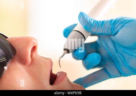 Ultraschall Reinigung der Zähne, close-up. Entfernung von Zahnstein und Plaque. Paradontitis, paradantoz. Zahnheilkunde, gesunde Zähne, schönes Lächeln. Stockfoto