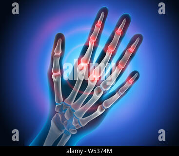 Hand mit Schmerzen in Gelenken - Arthritis - 3D-Darstellung Stockfoto