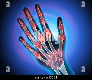 Hand mit Schmerzen in Gelenken - Arthritis - 3D-Darstellung Stockfoto