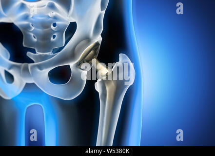 Künstliches Hüftgelenk closeup - 3D-Darstellung Stockfoto