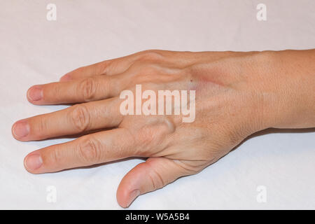 Die Folgen der Infusion mit fragilen oder Sklerotisches Venen am Arm Stockfoto