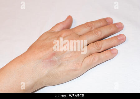 Die Folgen der Infusion mit fragilen oder Sklerotisches Venen am Arm Stockfoto