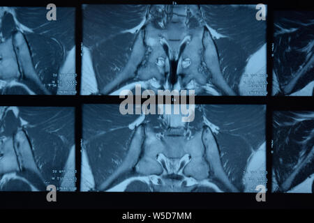 MRI sacroiliac Artikulation. Studie der ankylosierenden spondyloarthritis Patienten. Die Ergebnisse der Studie über die x-ray. Stockfoto