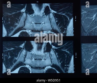 MRI sacroiliac Artikulation. Studie der ankylosierenden spondyloarthritis Patienten. Die Ergebnisse der Studie über die x-ray. Stockfoto