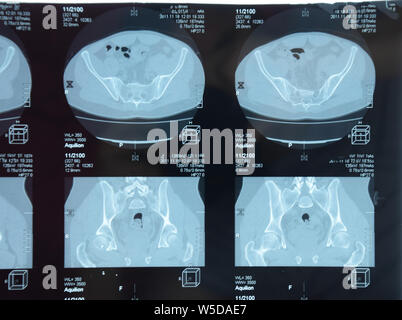 MRI sacroiliac Artikulation. Studie der ankylosierenden spondyloarthritis Patienten. Die Ergebnisse der Studie über die x-ray. Stockfoto