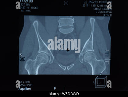 MRI sacroiliac Artikulation. Studie der ankylosierenden spondyloarthritis Patienten. Die Ergebnisse der Studie über die x-ray. Stockfoto