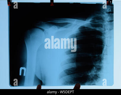 X-ray von Schulter und Schlüsselbein, X-ray Bild von schultergelenk. Stockfoto