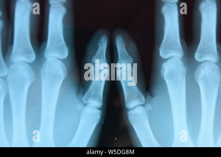 X-ray der Hände, ein Bild von den Knochen der Hände auf den x-ray. Stockfoto